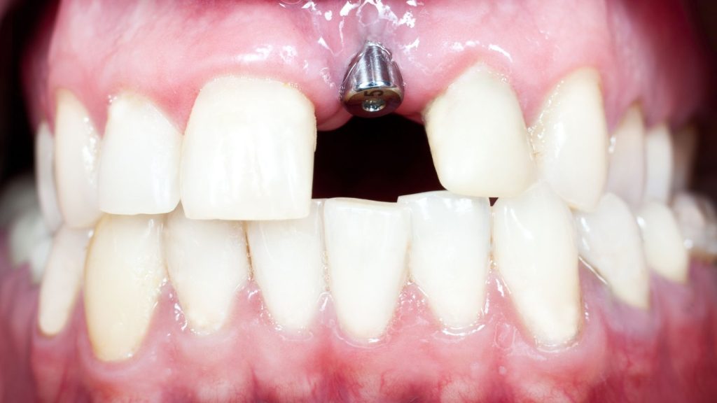 implantátumok