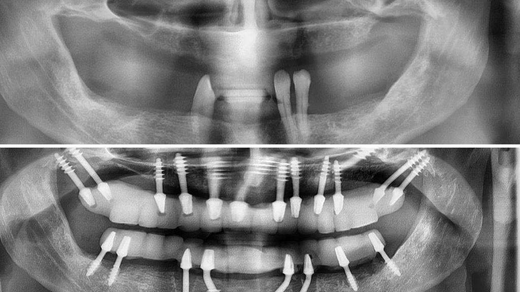 kortikobazális implantátumok